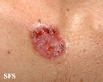 basal cell carcinoma