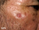 basal cell carcinoma