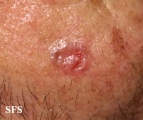 basal cell carcinoma