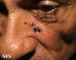 basal cell carcinoma