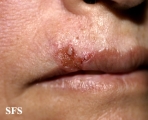 basal cell carcinoma