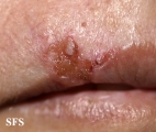 basal cell carcinoma