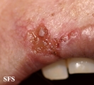 basal cell carcinoma