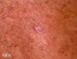 basal cell carcinoma