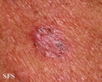 basal cell carcinoma