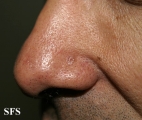 basal cell carcinoma