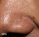 basal cell carcinoma