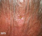 basal cell carcinoma