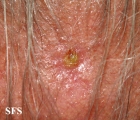 basal cell carcinoma