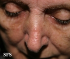 basal cell carcinoma