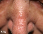 basal cell carcinoma