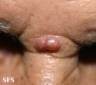 basal cell carcinoma