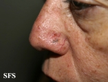 basal cell carcinoma