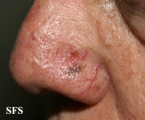 basal cell carcinoma