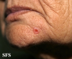 basal cell carcinoma