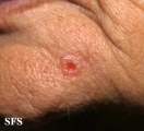 basal cell carcinoma