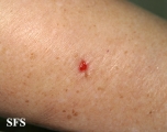 basal cell carcinoma