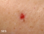 basal cell carcinoma