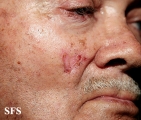 basal cell carcinoma