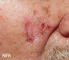 basal cell carcinoma