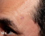 basal cell carcinoma