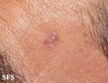 basal cell carcinoma