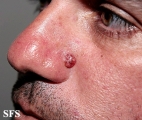 basal cell carcinoma