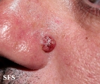 basal cell carcinoma