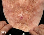 basal cell carcinoma