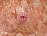 basal cell carcinoma