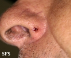 basal cell carcinoma