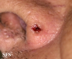 basal cell carcinoma
