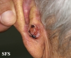 basal cell carcinoma