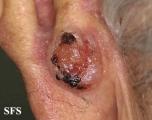 basal cell carcinoma