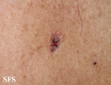 basal cell carcinoma