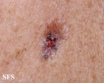 basal cell carcinoma