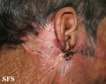 basal cell carcinoma