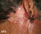 basal cell carcinoma