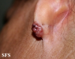 basal cell carcinoma