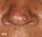 basal cell carcinoma
