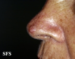 basal cell carcinoma