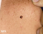 basal cell carcinoma