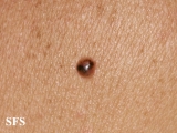 basal cell carcinoma