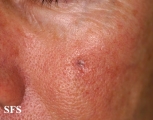 basal cell carcinoma