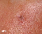 basal cell carcinoma