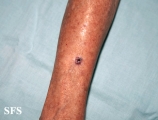 basal cell carcinoma