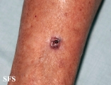 basal cell carcinoma