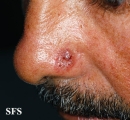 basal cell carcinoma