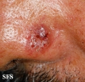 basal cell carcinoma