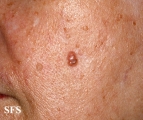 basal cell carcinoma